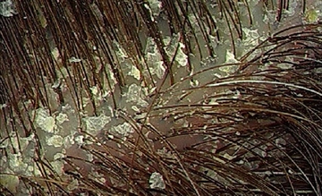 Saçta Kepek Belirtileri ve Tedavisi